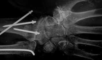 Fixation par broche suite à une fracture du poignet