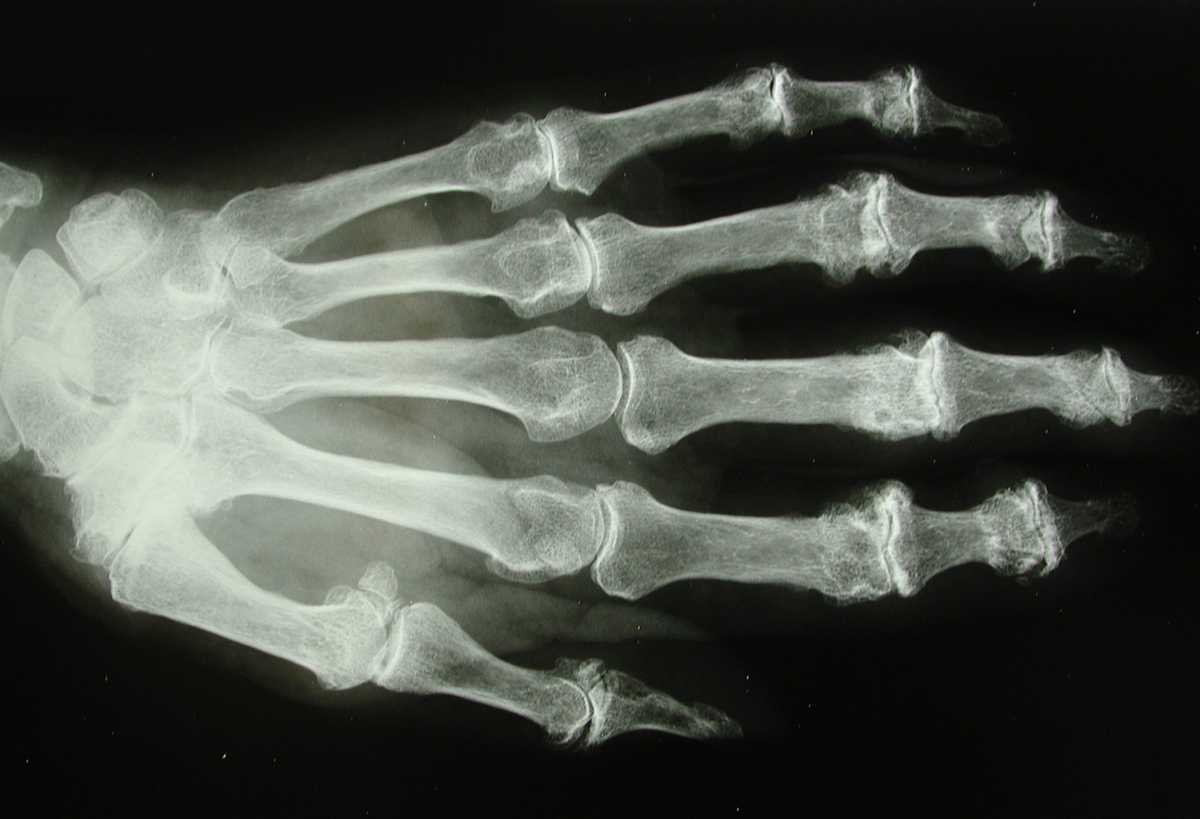 Diagnostic par radio à Paris de l'arthrose des doigts 