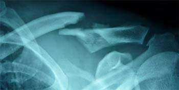 X-Ray of a fracture of the clavicle