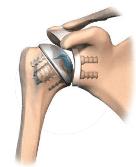 Prothèse d'épaule pour traiter chirurgicalement une omarthrose - arthrose de l'épaule