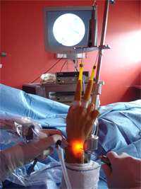 Chirurgie du poignet par arthroscopie