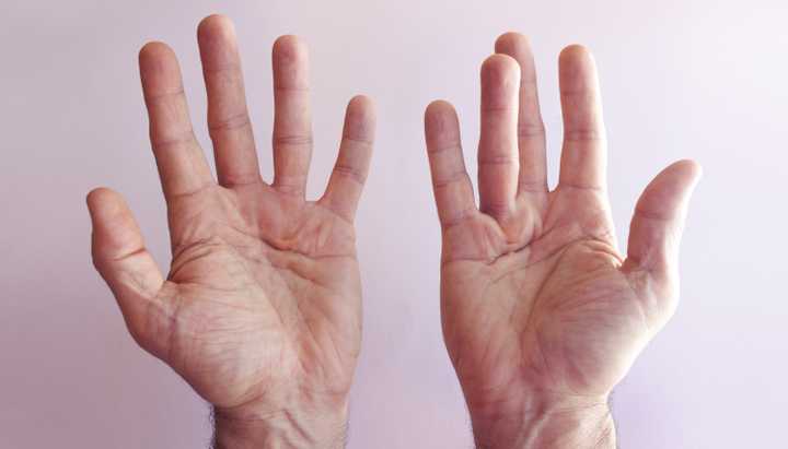 Dupuytren's contracture can be corrected by hand surgery