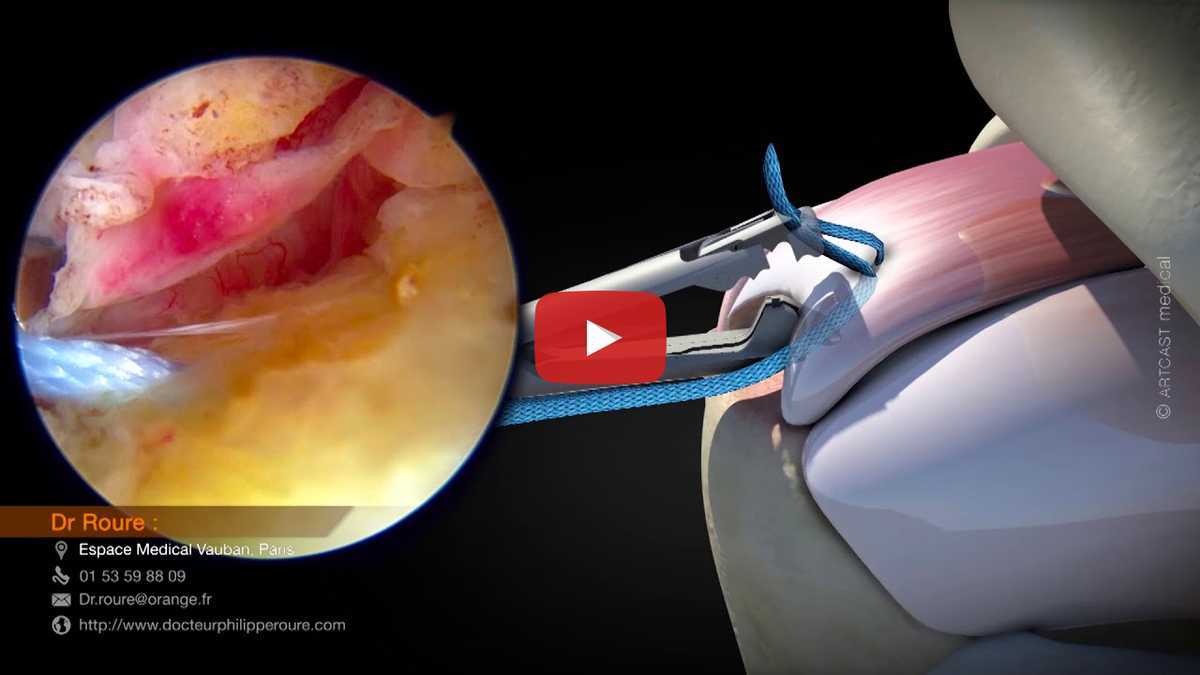 Vidéo sur la réparation des tendons de la coiffe des rotateurs par arthroscopie