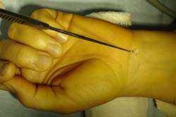 Traitement chirurgical du syndrome du canal carpien par endoscopie