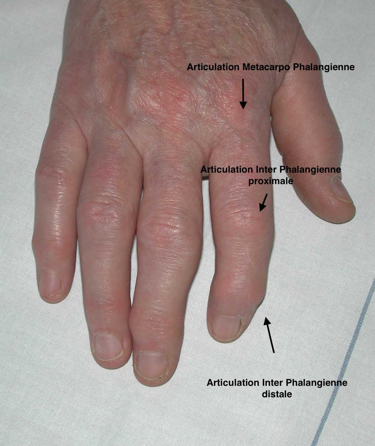 Anatomie des articulations concernées par l'arthrose des doigts