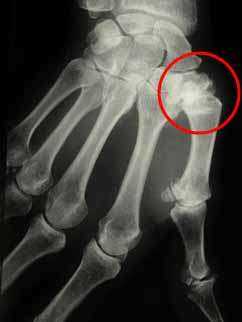 Thumb basal joint osteoarthritis X-Ray