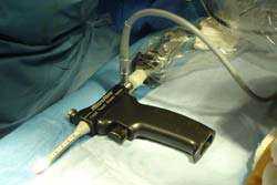 Appareil de chirurgie du syndrome du canal carpien par endoscopie